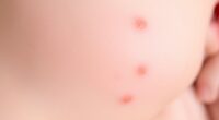benign newborn skin rashes