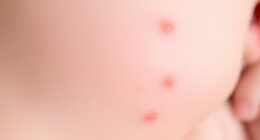 benign newborn skin rashes